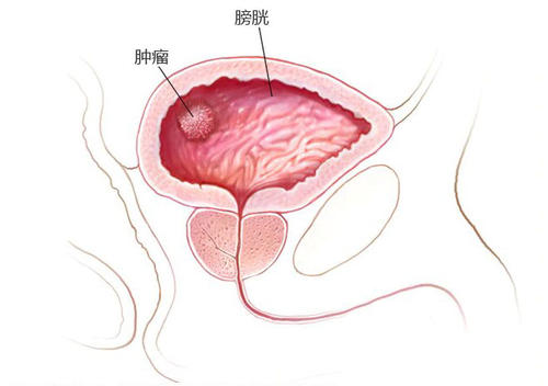 福州御和堂中医：早期膀胱癌有哪些症状